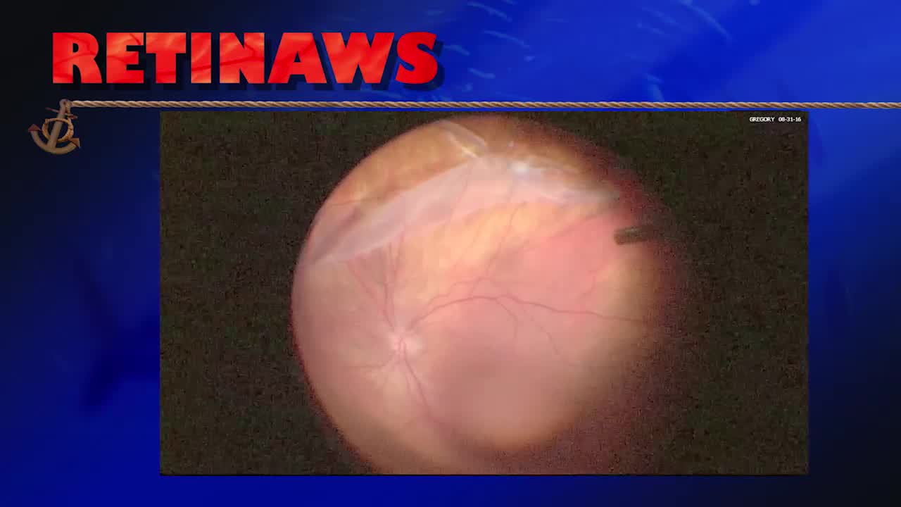 Giant Retinal Tear Detachment