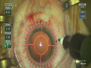 Femtosecond Cataract Surgery 