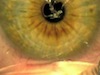 Forme Fruste ABMD and Reactive Epithelial Syndrome in LASIK