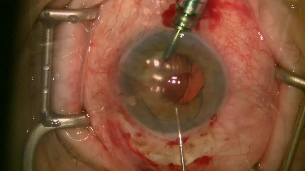 UGH Syndrome - IOL Exchange, 4 Point Gortex Fixated, and Endoscopic Cyclophotocoagulation 
