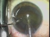 Flip and Slice Cataract Surgery Using Healon Endcoat and Healon5