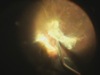 Vitrectomy for Chronic Diabetic Retinopathy