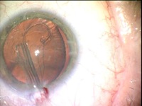 Malyugin Modified CTR in Patient with Traumatic Zonular Dialysis