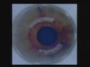 Paired Intrastromal Arcuate Incision