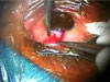 Non-Penetrating Deep Sclerectomy with Canalectomy