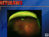 Subrachoroidal Hemorrhage Drainage via Inferior Sclerotomies 