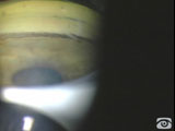 Plateau Iris Syndrome