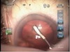 Mackool Hydrodissection Cannula
