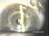 Intracorneal Ring and Cataract Surgery