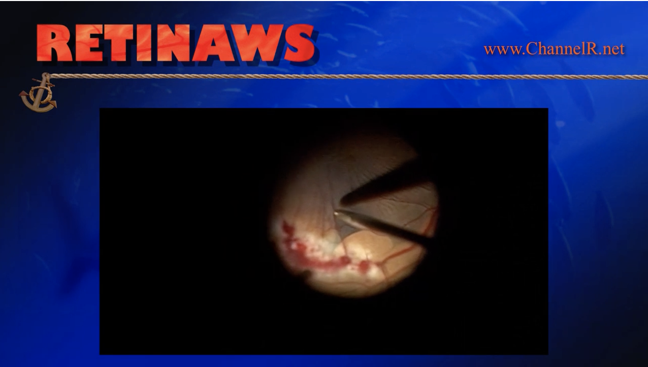 Avulsed Retinal Vessel - Eyetube