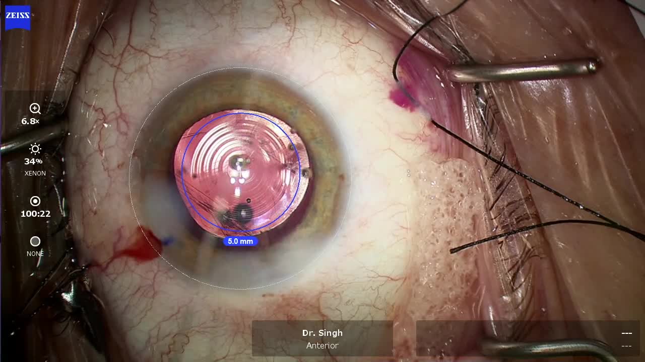 Placing a Multifocal IOL With a Ruptured Posterior Capsule