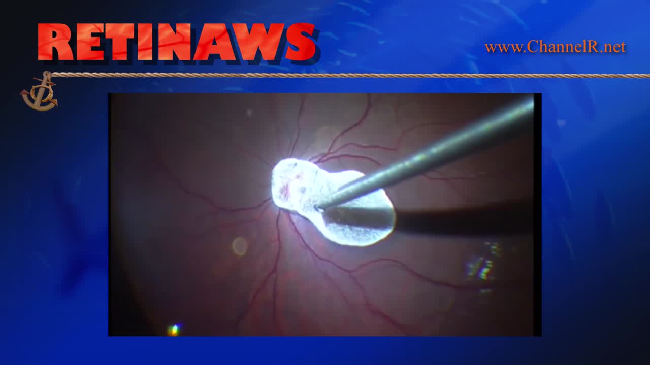 Optic Nerve Pit