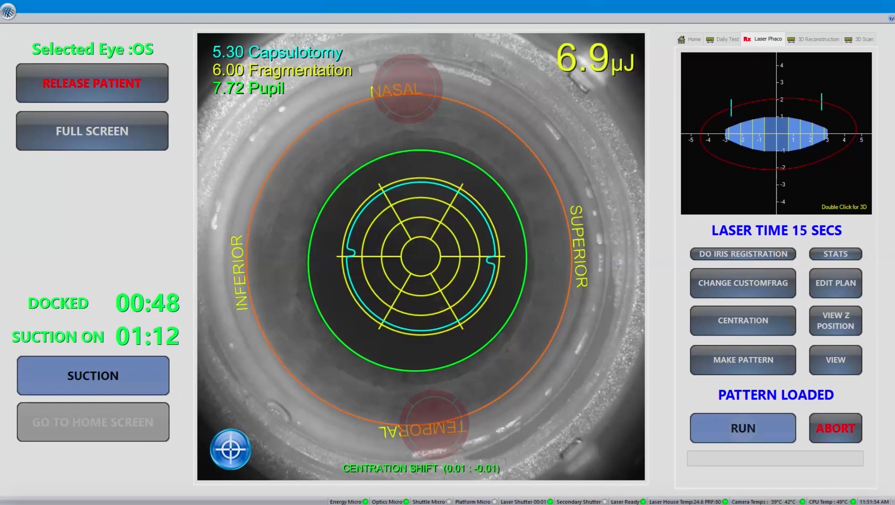 The LENSAR<sup>®</sup> Laser System Makes Complex Cases Routine