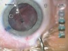 Removal of Intralenticular Foreign Body
