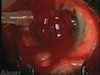 Acute Suprachoroidal Hemorrhage...