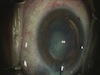 Traumatic Cataract with Ahmed CTS Placement
