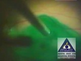 Indocyanine Green Assisted Maculorhexisis