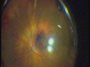 Phacovitrectomy of Macula Pucker