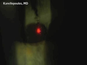 Nd:YAG Capsulotomy in a Young Psedophake