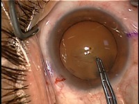 Devgan Rhexis Forceps