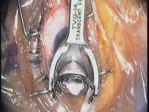 iStent placement with Transcend Vold Goniolens