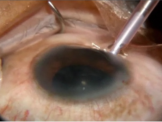 Cataract Surgery With Extreme Positive Pressure