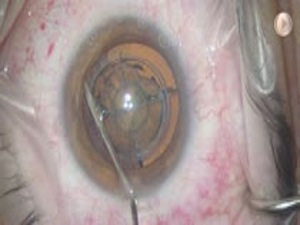 Zero Ultrasound Cataract Surgery