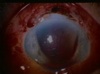 Suprachoroidal Hemorrhage/C14F24