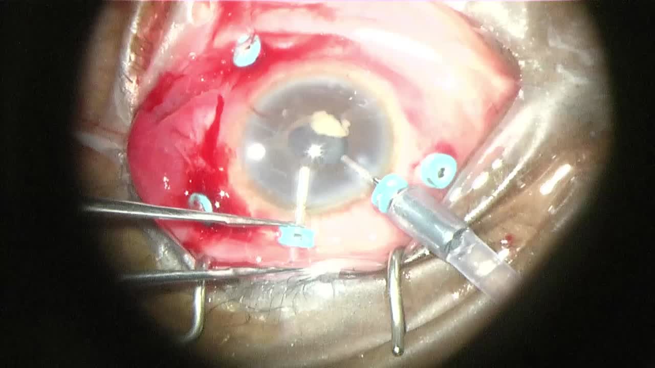 Combined Limbal-Based Vitrectomy With Pars Plana Vitrectomy