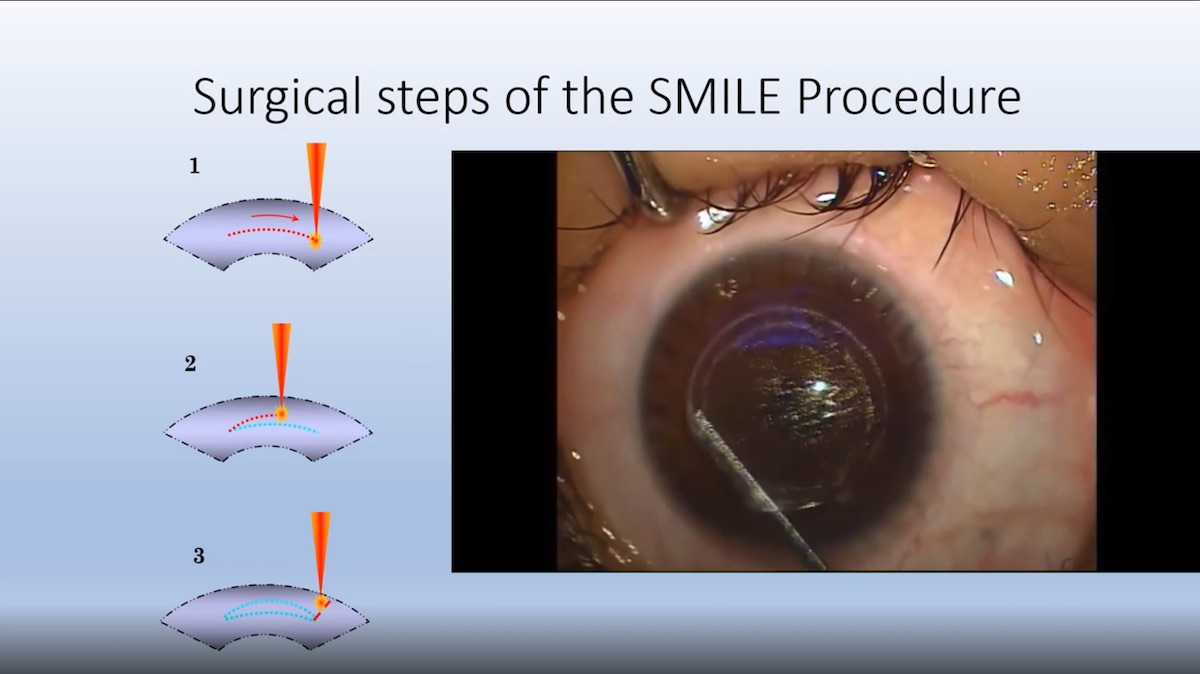 Lasik-to-SMILE Journey Part 1
