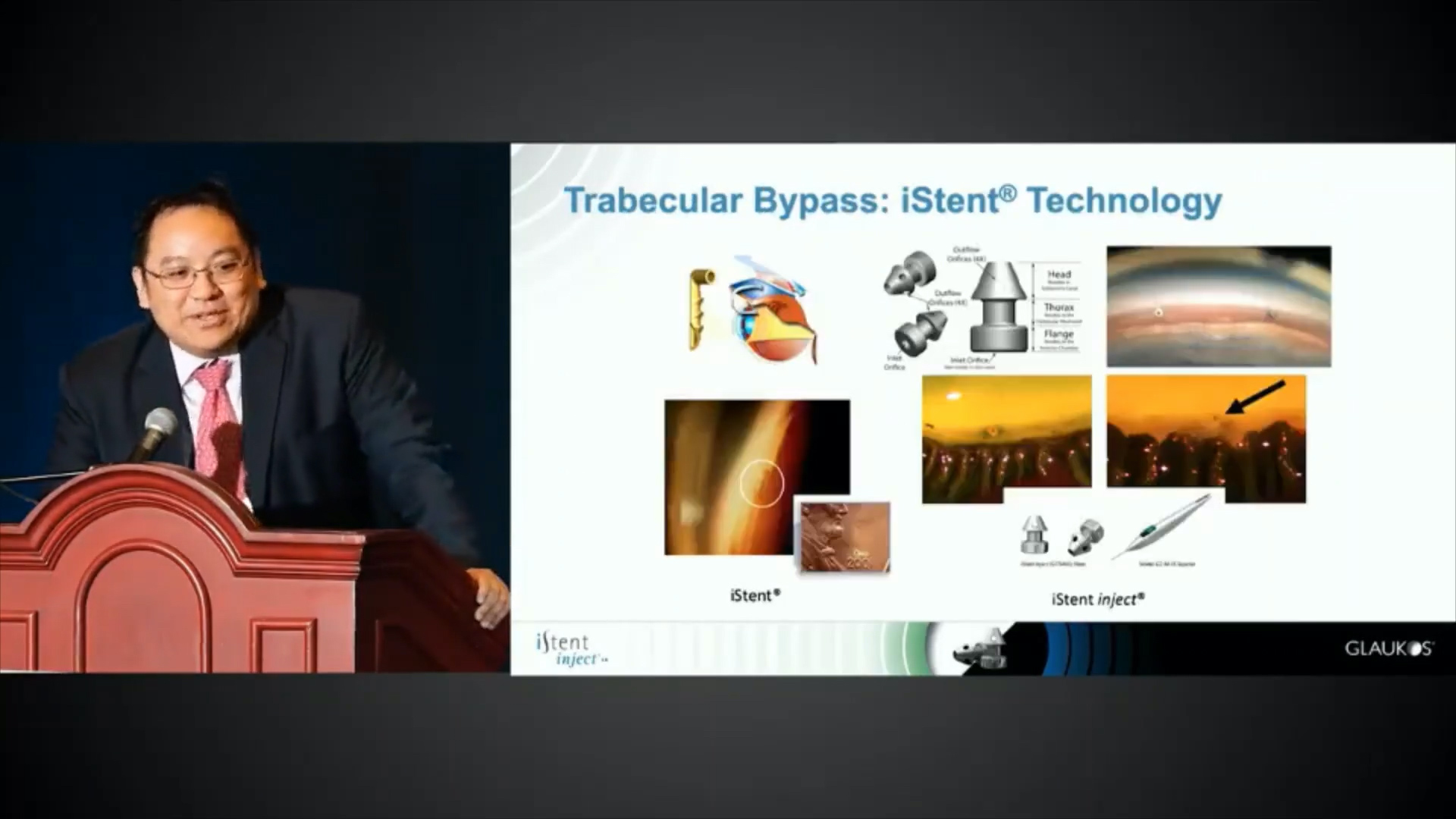 Outflow Imaging and Trabecular Bypass
