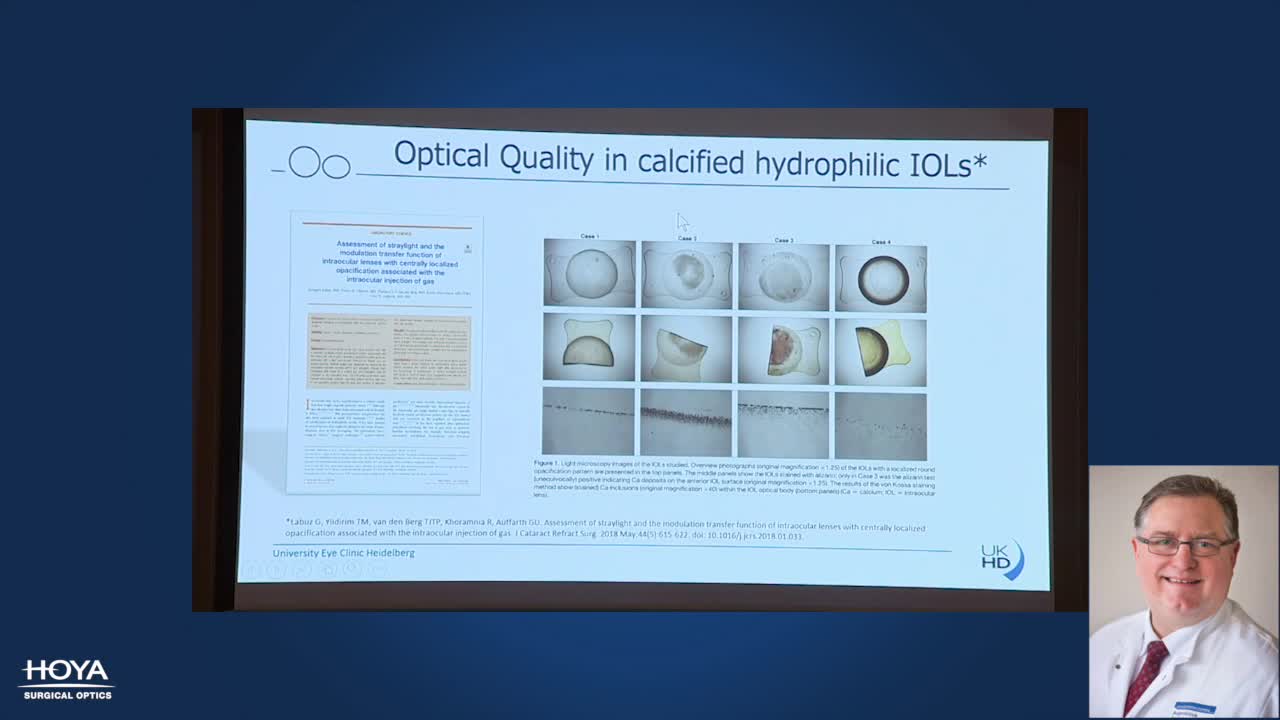 The Vivinex IOL Platform: Providing long-term optical clarity