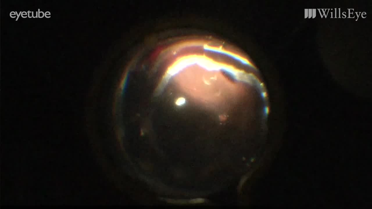 Nonclearing Vitreous Hemorrhage and More