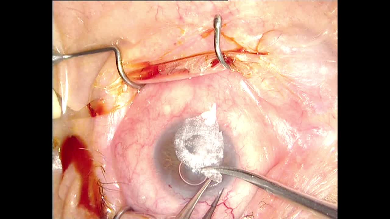 Lyophilised Amniotic Membrane for Corneal Ulcer