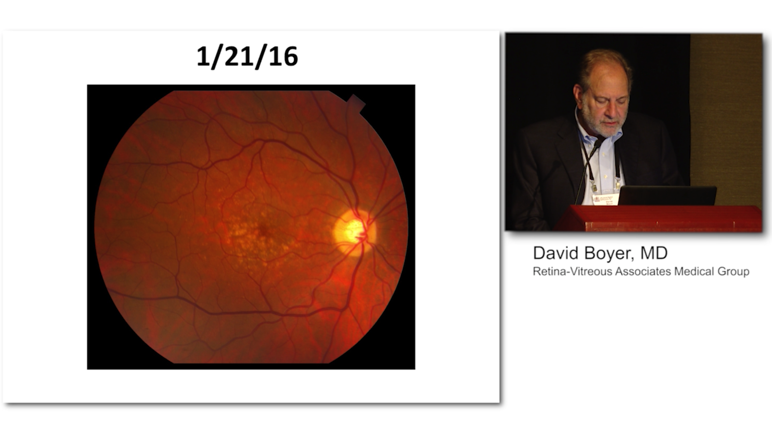 OCT-A May Provide Better Visualizations of Vascularized PED's in AMD patients than FA