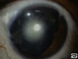 Traumatic Reconstruction of Iris