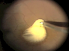 Management of Suspected Endogenous Endophthalmitis: Part 1