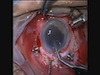 Scleral-Fixated IOL Using 25-Gauge Needle Scleral Tunnel 