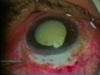 Subluxed Nucleus