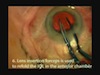 Intraocular Exchange Technique