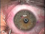 Using the Terry-Schanzlin Astigmatome (Case 2)