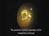 25-Gauge Vitrectomy for the Treatment of Central Retinal Artery Occlusion