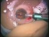 Flexible Lid Speculum with a Drape