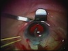 Cataract, Pseudoexfoliation, and Glaucoma