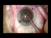 Improving Anterior Chamber Stability