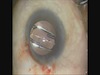 My First Insertion of the enVista Lens Implant - Eyetube