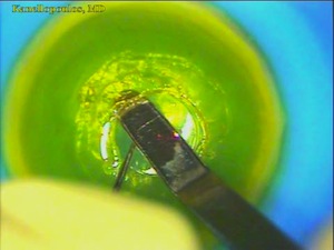 KeraKlear II Foldable Acrylic Inlay Keratoprosthesis