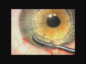 Artiflex Implantation