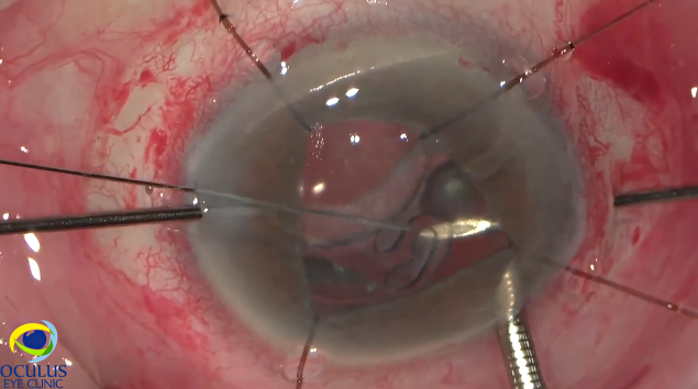 Posterior Lamellar Keratoplasty and Dislocated IOL