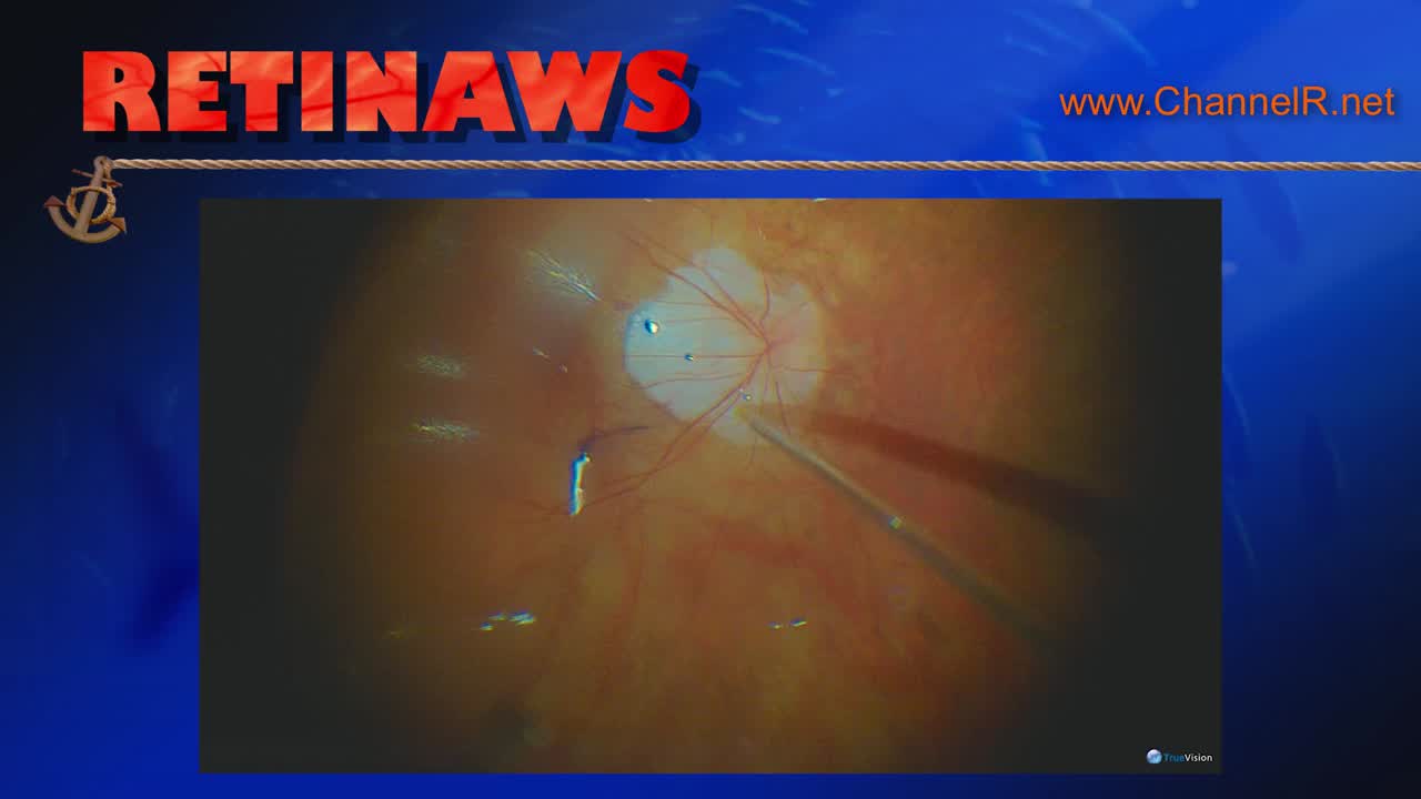 Autologous ILM Transplantation